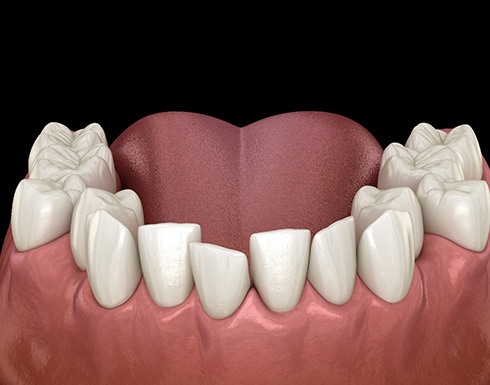 Illustration of crooked teeth