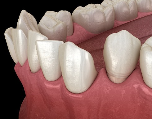 Illustration of gapped teeth