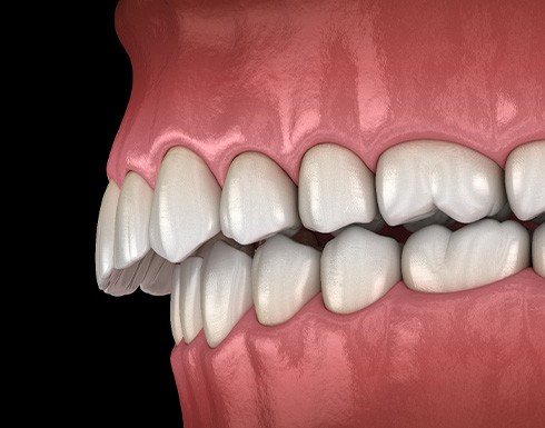 Illustration of gapped teeth