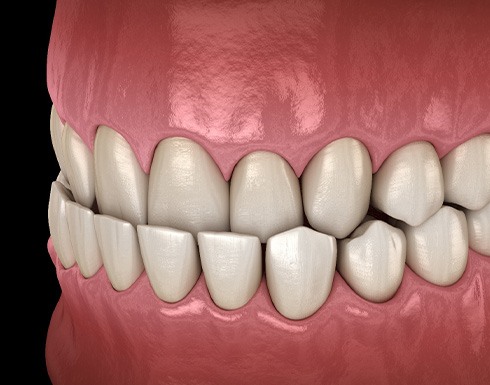 Illustration of an underbite