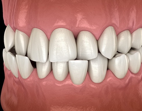 Illustration of a crossbite