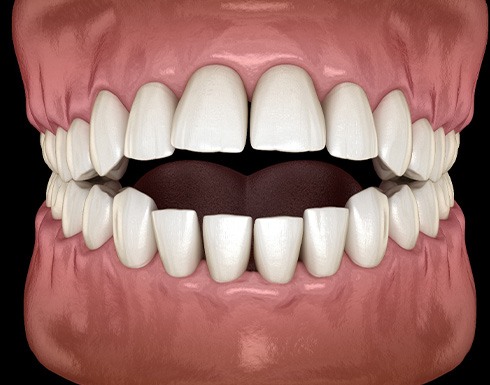 Illustration of an open bite