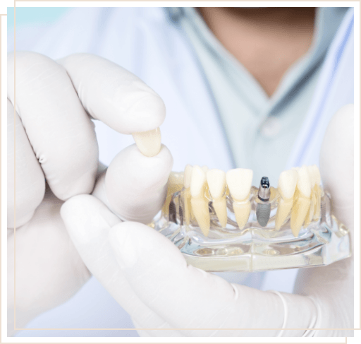 Dentist holding dental crown in one hand and model of mouth with dental implant in the other