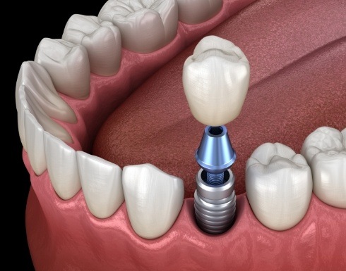 Dental crown being placed onto a dental implant