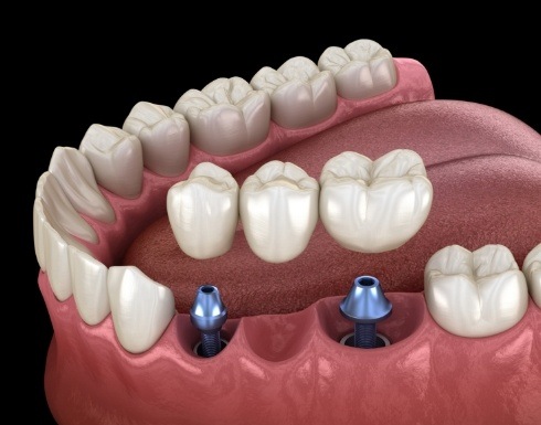 Dental bridge being placed onto two dental implants