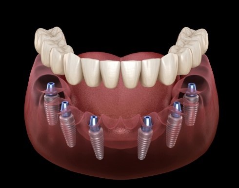 Full denture being placed onto six dental implants