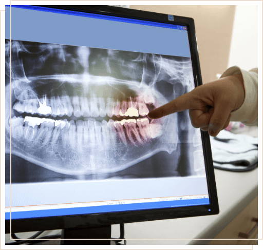 Dentist pointing to x ray of teeth