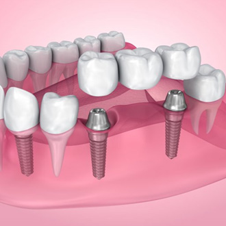 Exploded image of dental implants with bridge