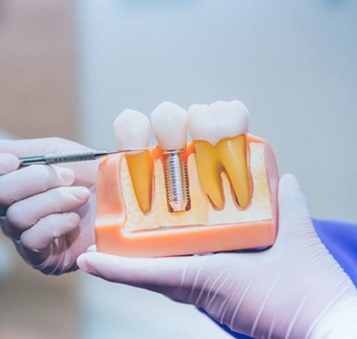 a dentist holding a model of dental implants