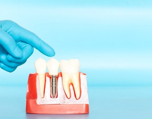 a model of dental implants