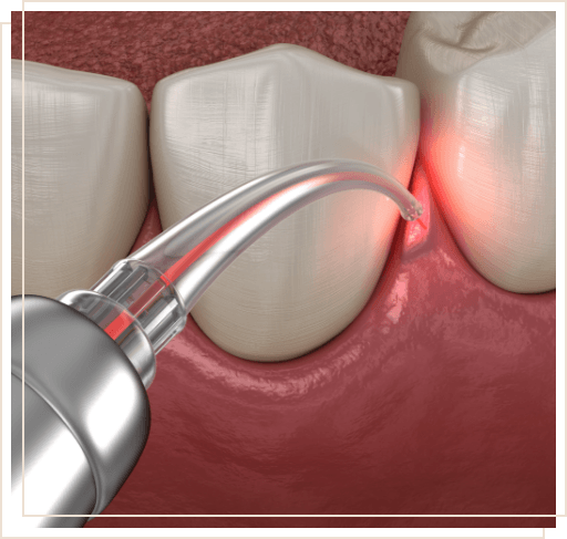 Illustrated dental instrument applying topical antibiotic to gums