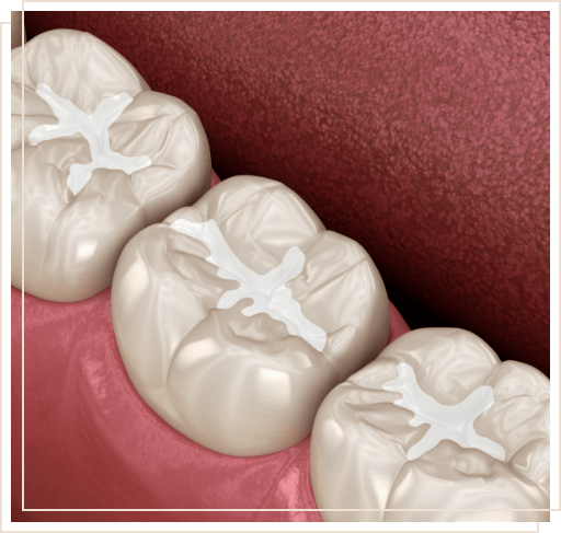 Illustrated row of teeth with barely noticeable dental sealants