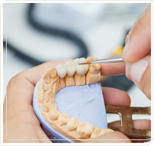 Dentist holding model of jaw with dental bridge over three teeth