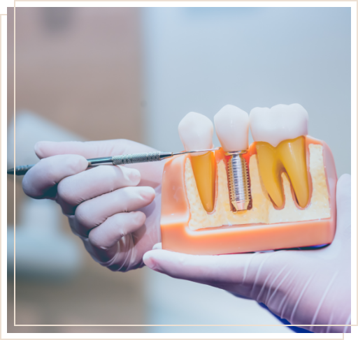 Dentist holding model of dental implant in the jaw