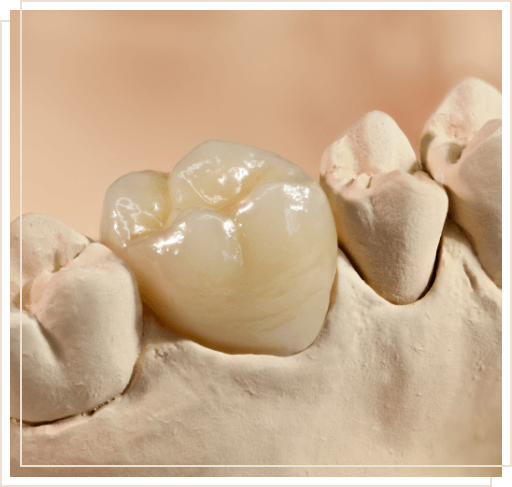 Model of the mouth with dental crown over one tooth