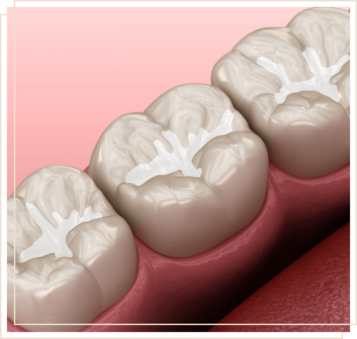 Close up of illustrated tooth with barely noticeable tooth colored filling