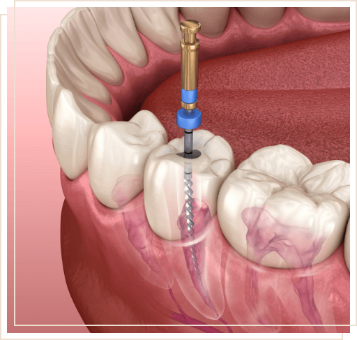Illustrated dental instrument cleaning inside of a tooth