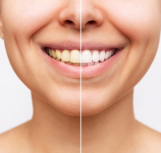 Closeup of patient's teeth before and after teeth whitening