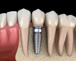 Model of a dental implant replacing a tooth