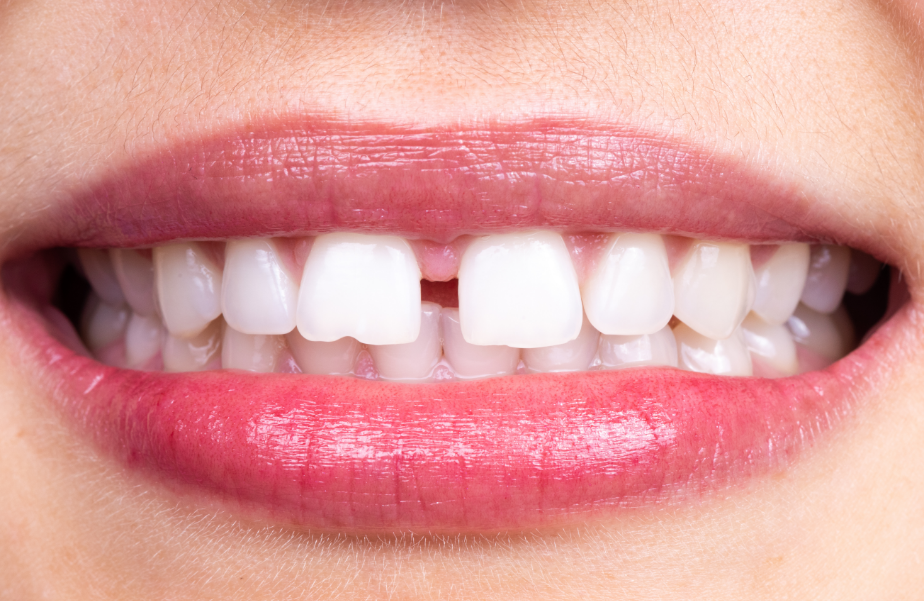 Woman's smile with a tooth gap