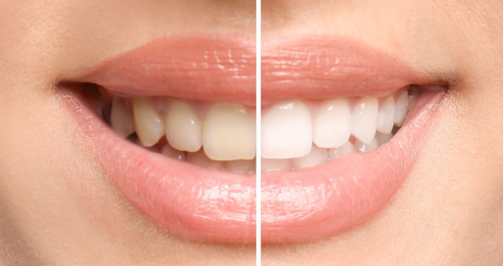 Closeup of someone smiling to show before/after of teeth whitening