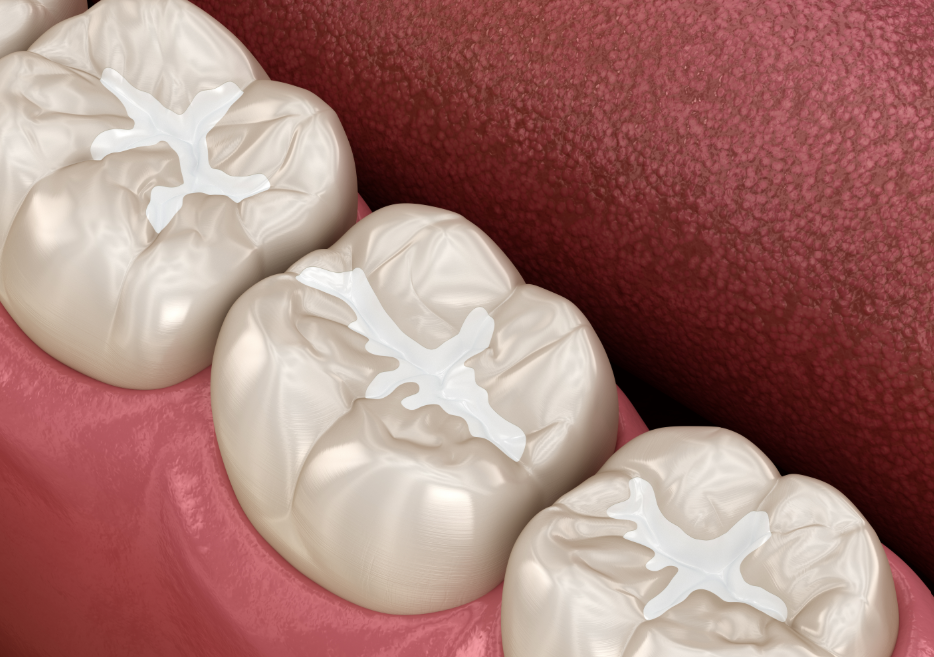 3D image of tooth-colored fillings in teeth