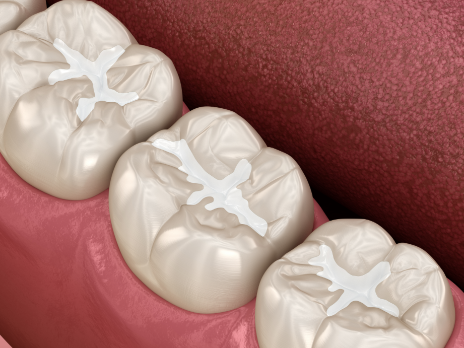 Teeth with amalgam filling